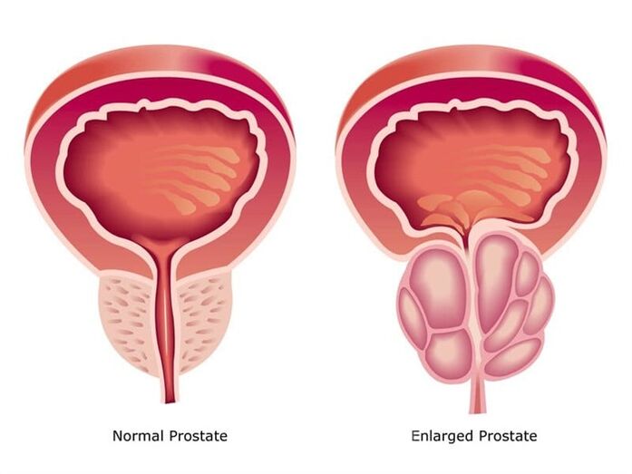 Prostovit normalizuje práci a velikost prostaty