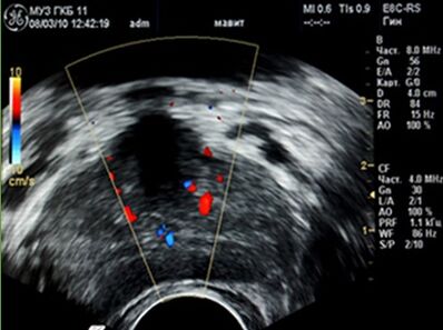 Ultrazvuk ukázal ložiska zánětu v prostatě