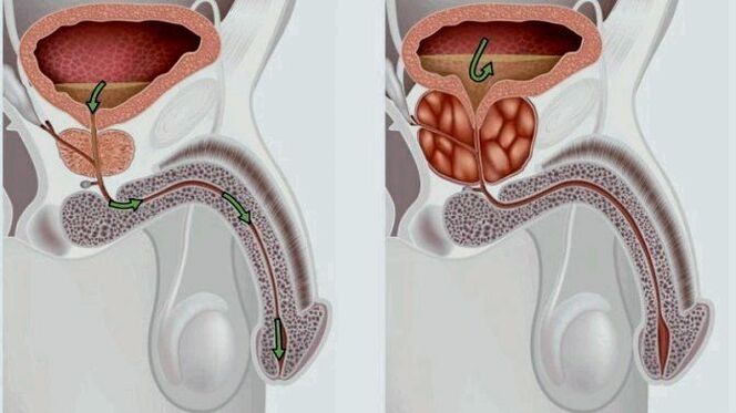 zdravá a zanícená prostata s prostatitidou
