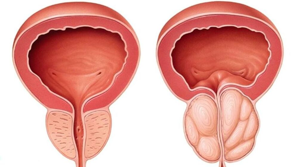 normální a zvětšená prostata