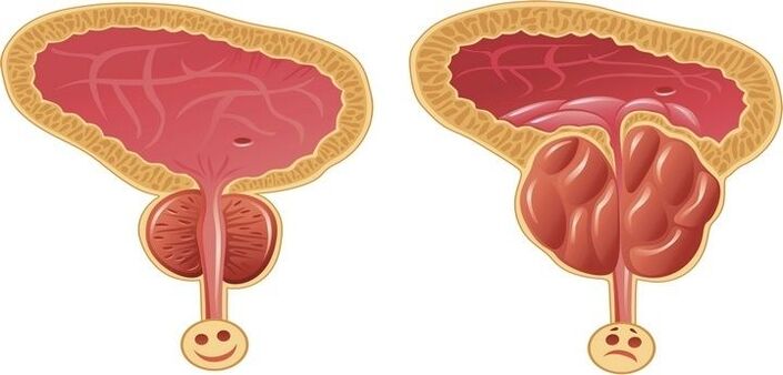 zdravá a zanícená prostata