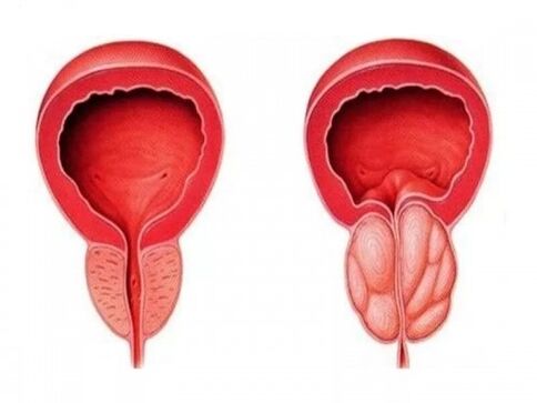 Zdravá a zanícená prostata